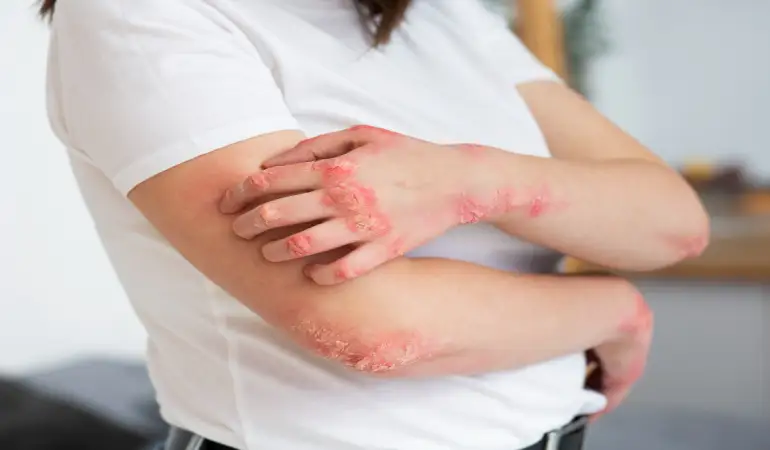 What Causes Itching and Redness in the Body? What is the treatment?