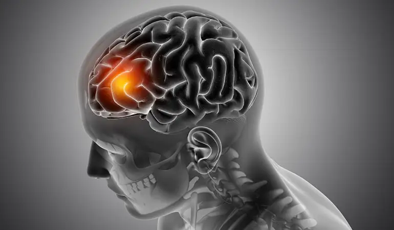 Multiple Sclerosis (MS): Symptoms and Treatment